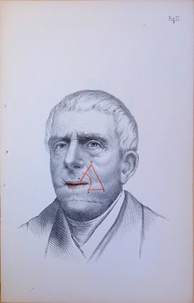 (1)...Partial reconstruction of the face. (2) ...Reconstructing lower lip. Offprints inscribed by the author.