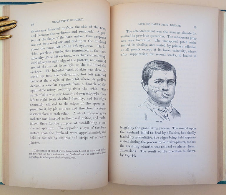 Book Id: 40011 Contributions to reparative surgery. 86 wood-engraved illustrations. Gurdon Buck.