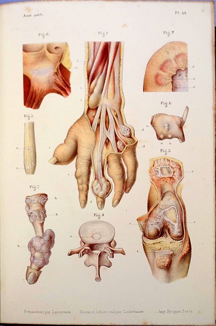 Book Id: 43448 Atlas d’anatomie pathologique. 2 vols. (text and atlas). Etienne Lancereaux.