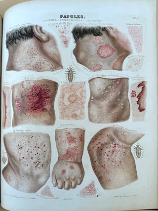 Traité théorique et pratique des maladies de la peau. 2nd ed., revised and expanded. 3 vols. plus atlas