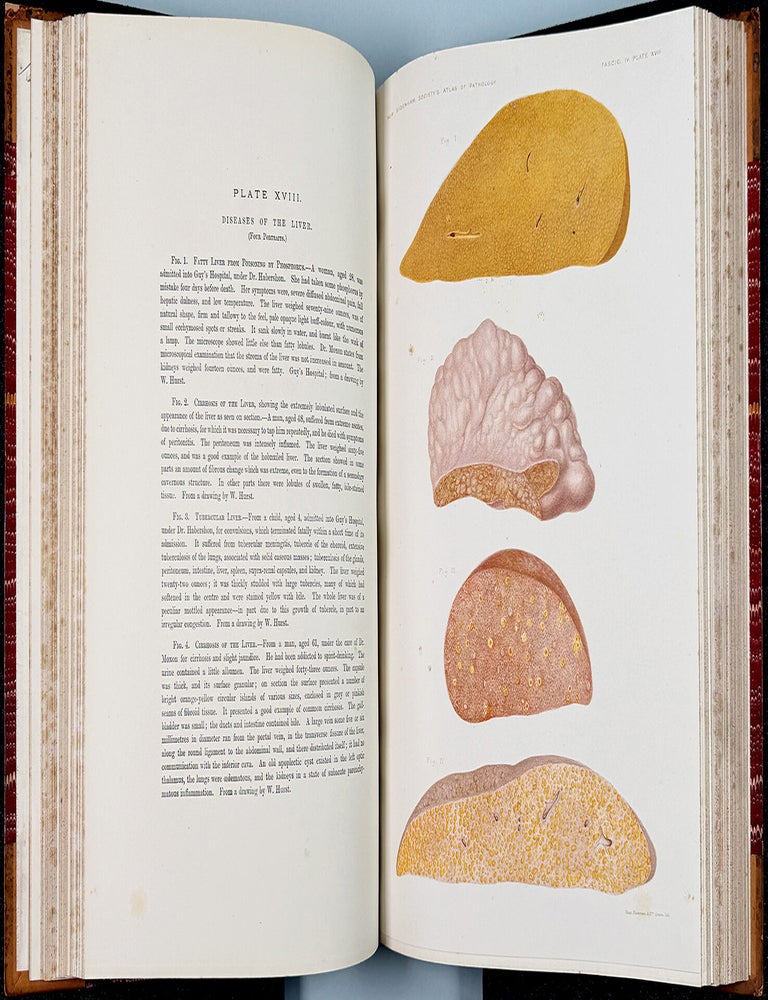 Book Id: 52345 An Atlas of Illustrations of Clinical Medicine, Surgery, and Pathology. Jonathan Hutchinson, New Sydenham Society.
